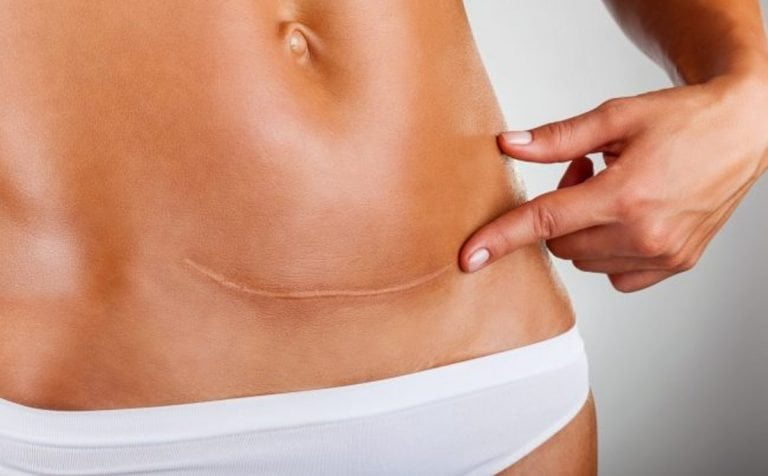 c-section operation scar