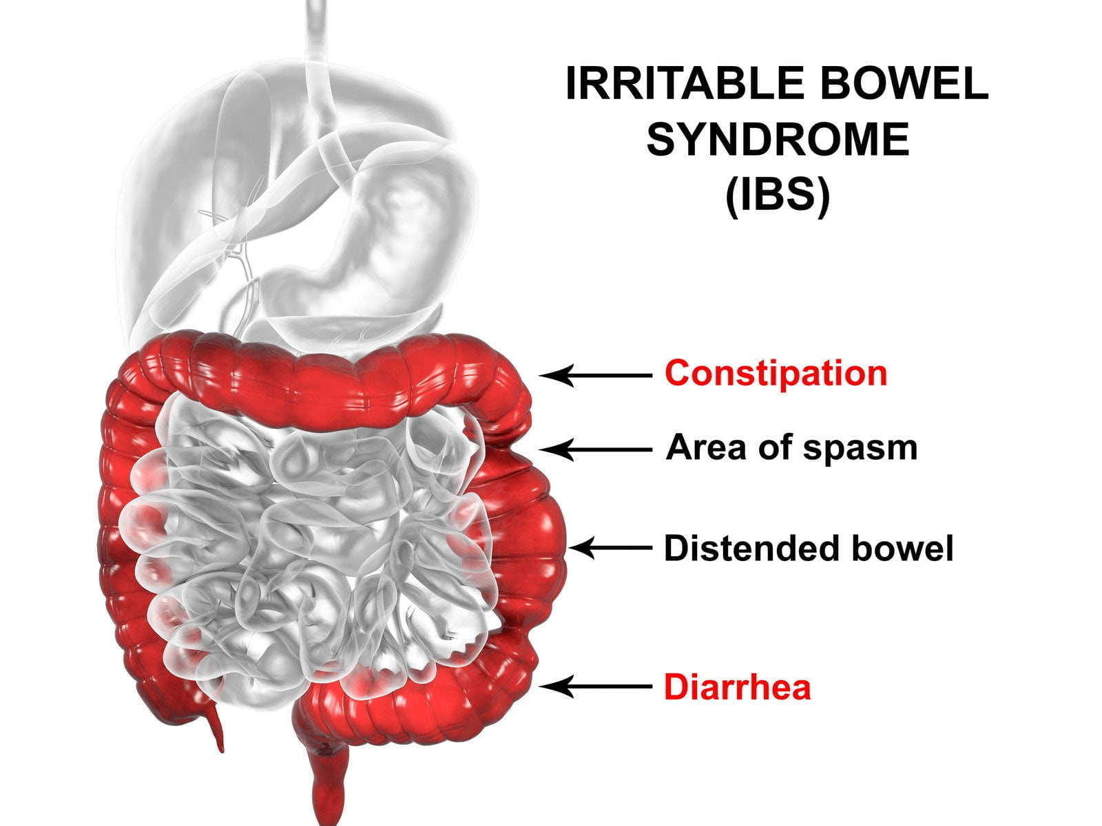 Irritable Bowel Syndrome (IBS)