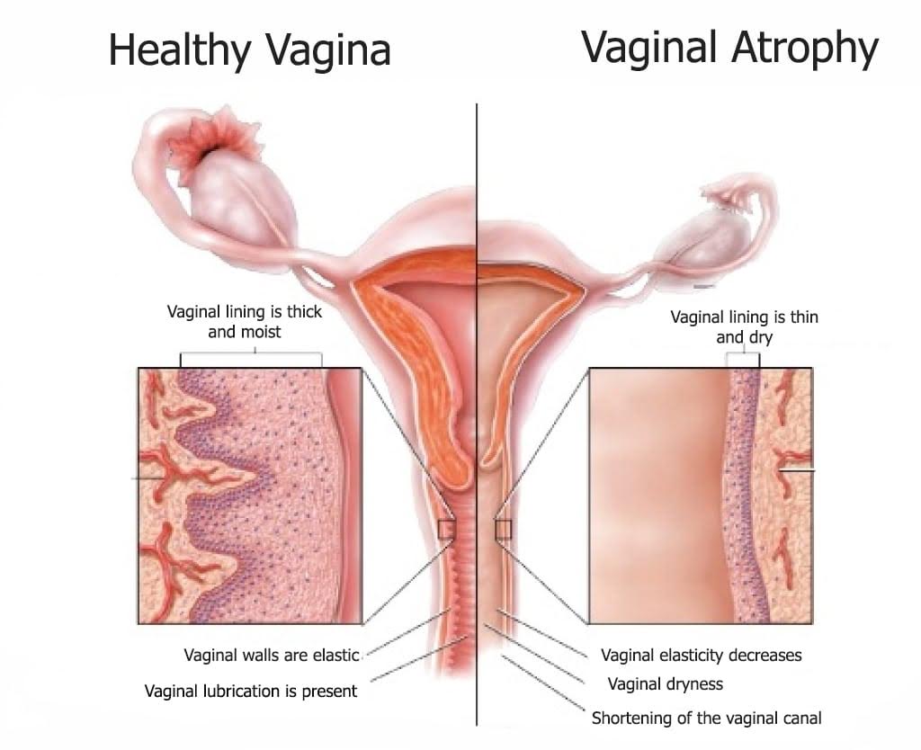 Postmenopausal Vaginal Atrophy