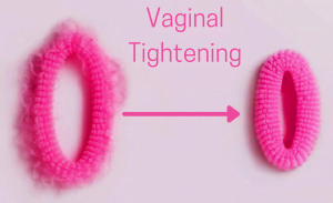 Vaginal Tightening
