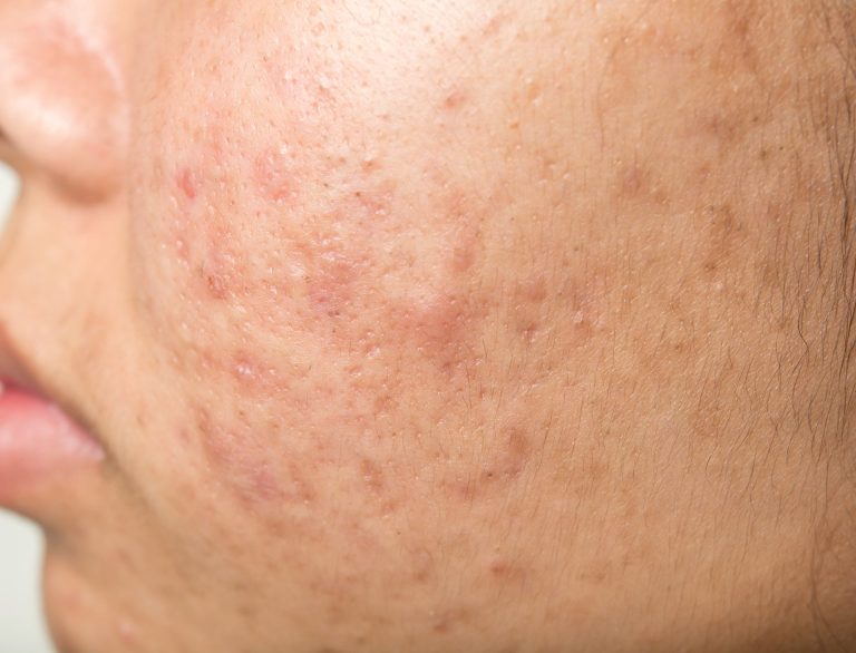 acne scars