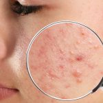 acne scars