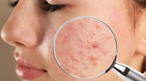 acne scars