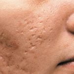 atrophic scar