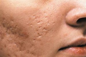atrophic scar