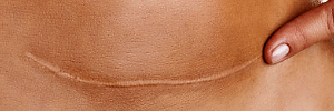 Scarless Silicone Scar Gel | C-Section Operation Scar Image