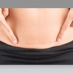 c-section operation scar