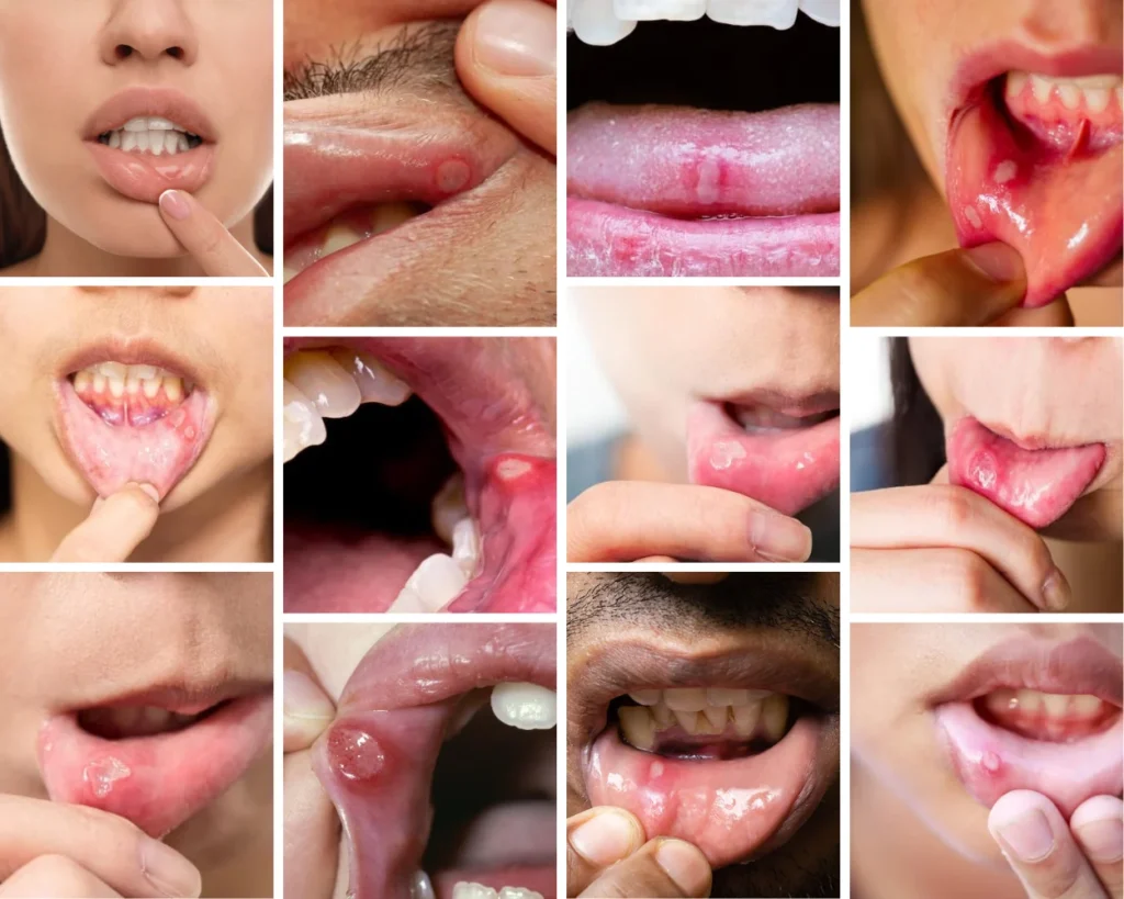 Examples of canker sores (mouth ulcers) on the inner lip, gums and tongue
