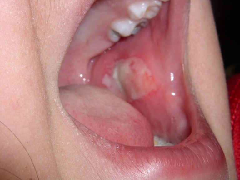 cheek bites cause mouth ulcers