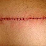 fresh stitches