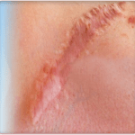 hypertrophic scar