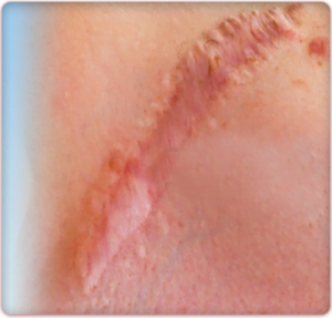 hypertrophic scar