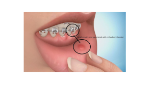 mouth ulcer from orthodontic braces