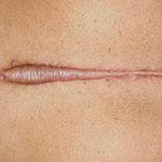 Scarless Silicone Scar Gel | Keloid Scar Image