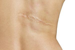 scar on back
