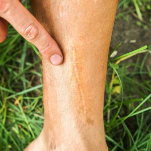 leg scar