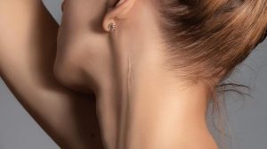 side neck scar