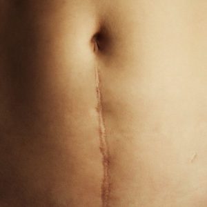 stomach scar