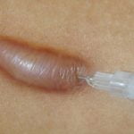 Scar steroid injection