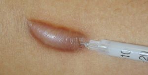 scar steroid injection as a scar treatment option