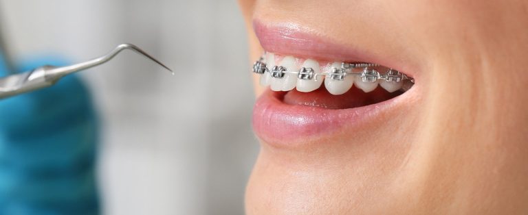 woman with braces